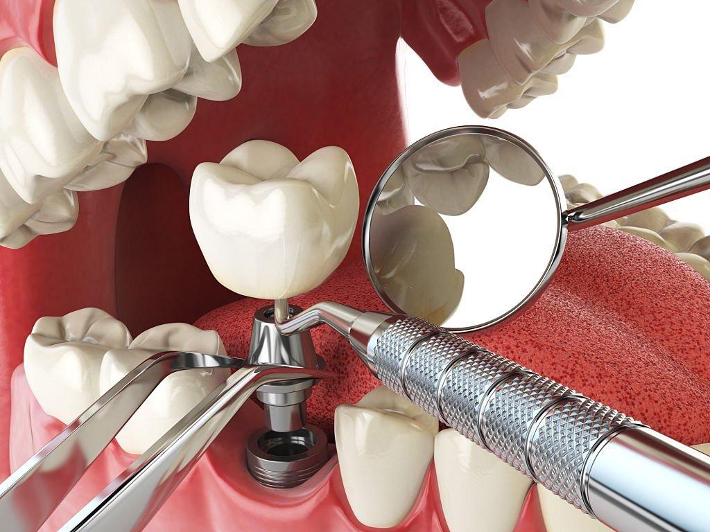 Dental implants offer numerous advantages compared to other tooth replacement options, such as bridges or dentures.